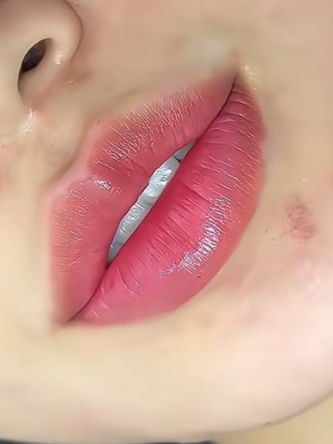 Marire buze cu acid hialuronic made by Ioana Tuș - from Stailer