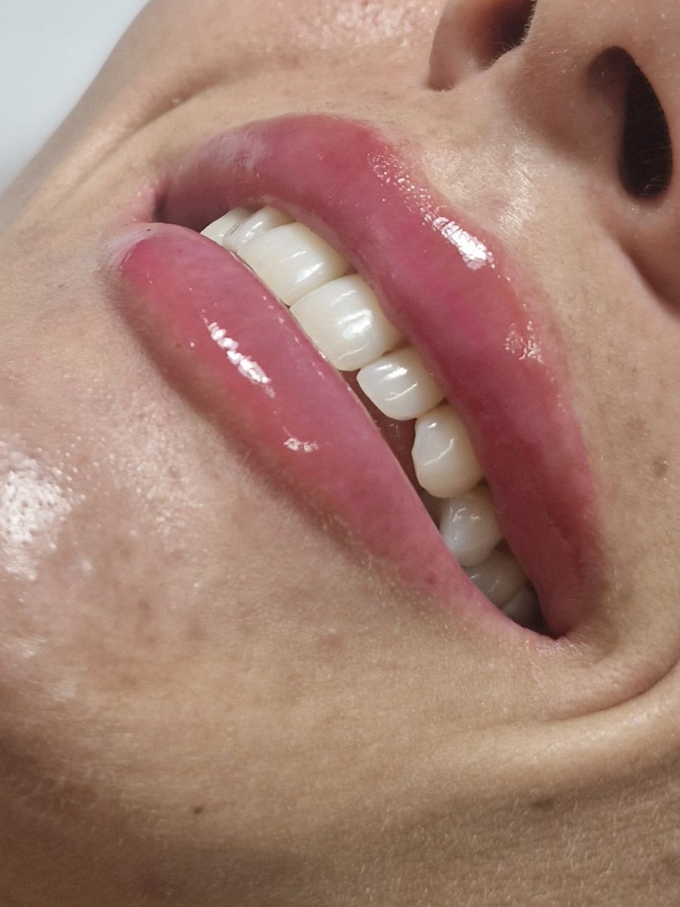 Marire buze cu acid hialuronic made by Ioana Tuș - from Stailer