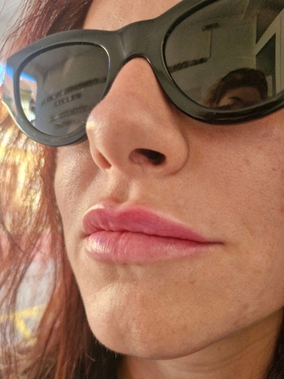 Marire buze cu acid hialuronic made by Ioana Tuș - from Stailer