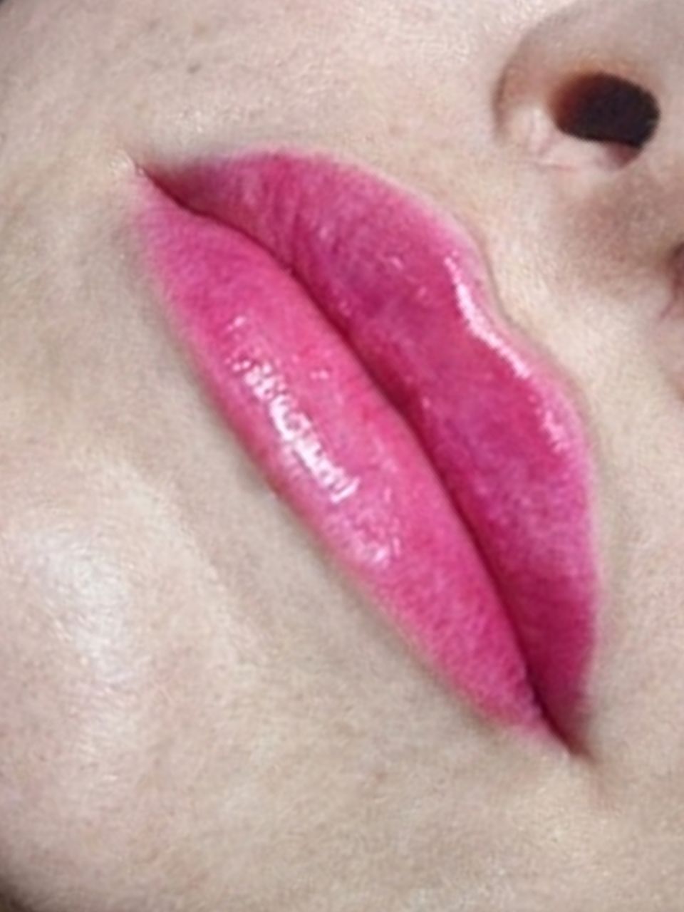 Marire buze cu acid hialuronic made by Ioana Tuș - from Stailer