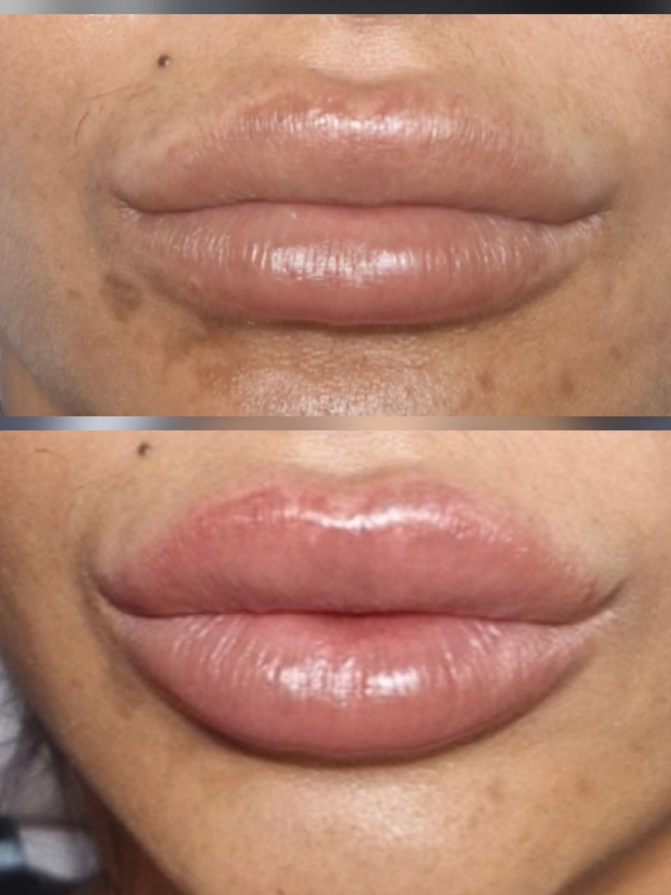 Marire buze cu acid hialuronic made by Ioana Tuș - from Stailer