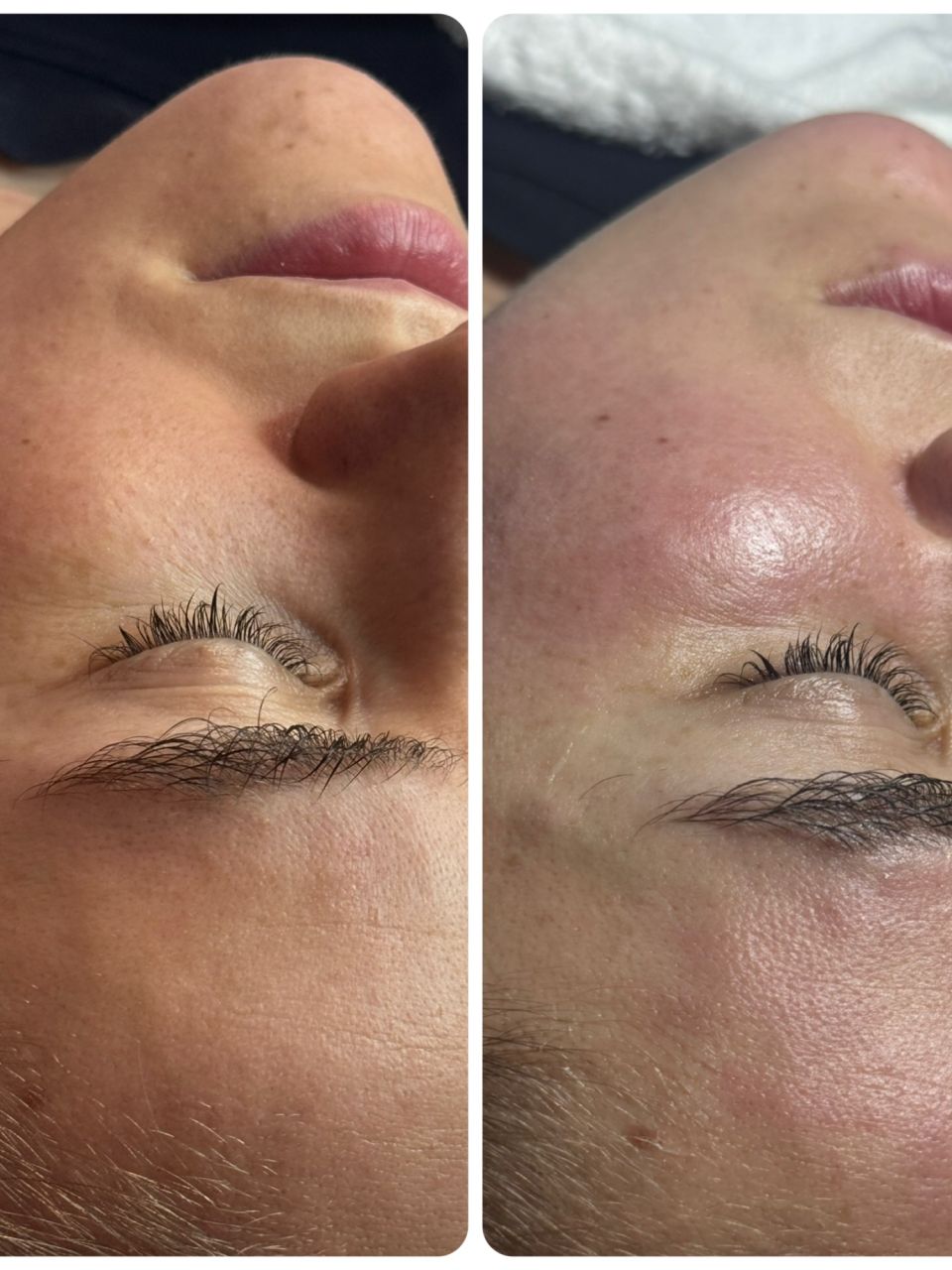 Microneedling made by Mihalea Alexandra  - from Stailer