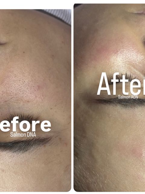 Microneedling made by Mihalea Alexandra  - from Stailer