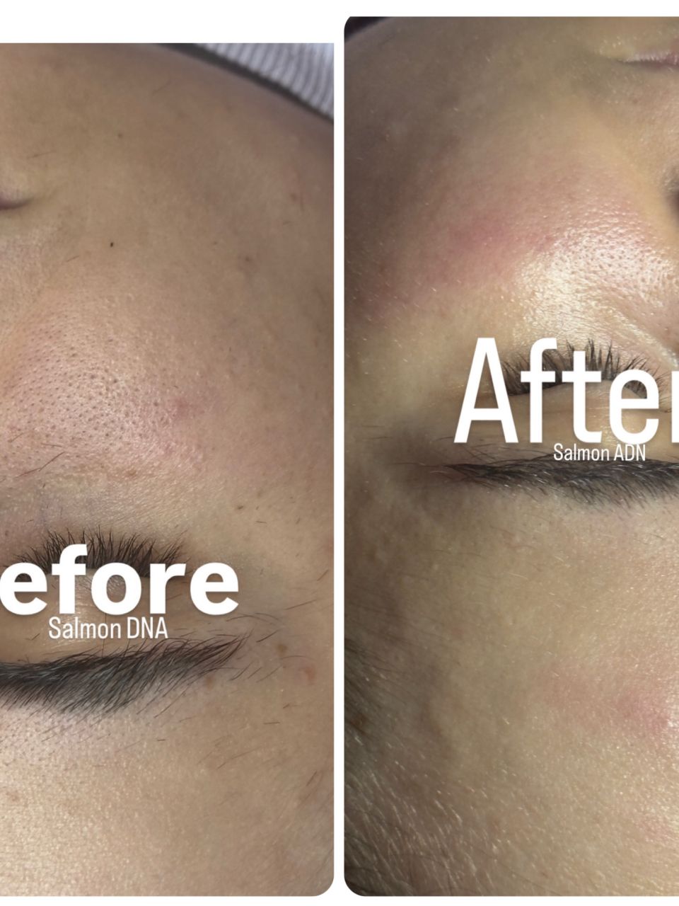 Microneedling made by Mihalea Alexandra  - from Stailer